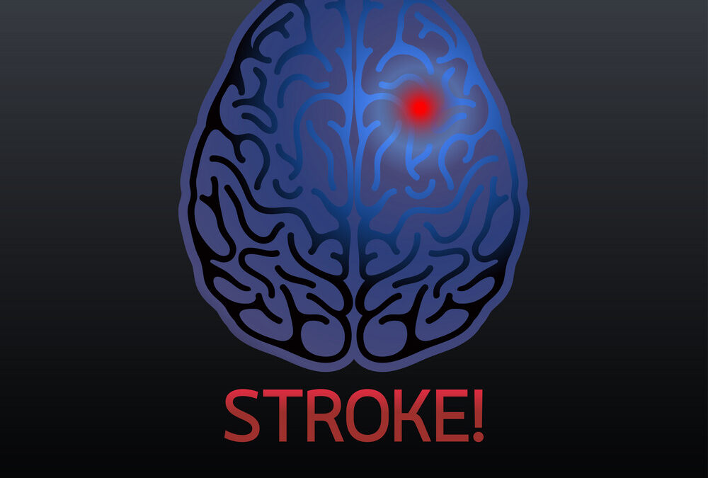 Stroke Smarts
